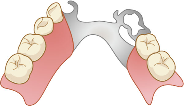 一般的な入れ歯の治療